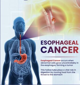 Esophageal Cancer