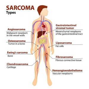 Types of Sarcoma